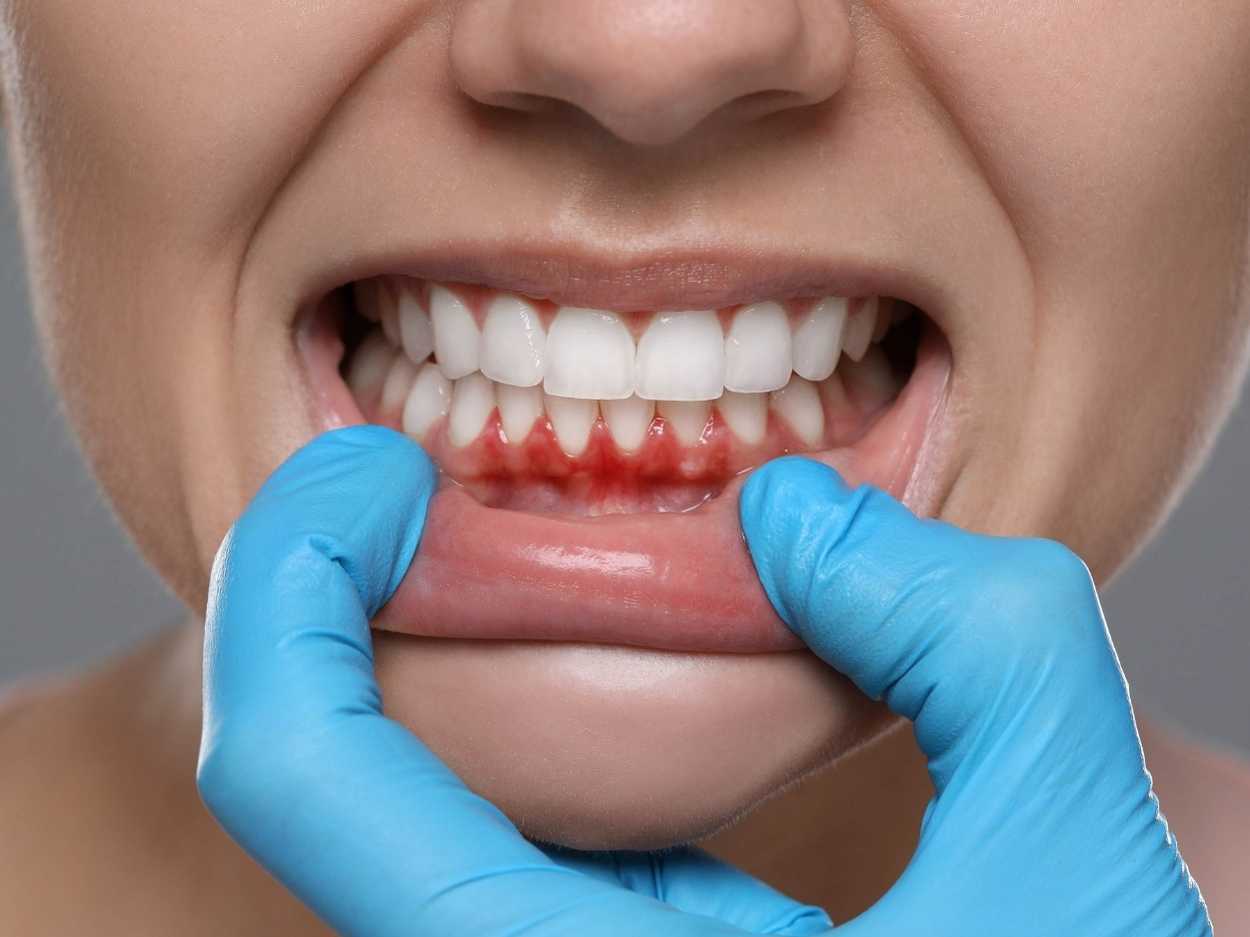 Diş Eti Tedavileri (Periodontoloji)